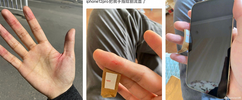 Пользователи iPhone 12 проливают кровь. Для некоторых корпус смартфона оказался слишком острым